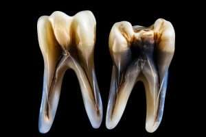 tooth infection Q&A with Abington Center, an emergency dentist in NEPA.
