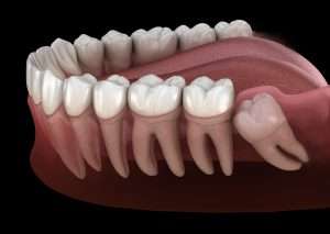 impacted wisdom tooth, learn more with Abington Center of Cosmetic & Family Dentistry, a local dentist located in Clarks Summit, PA.