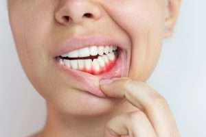 image of inflamed gums - why do my teeth bleed when i brush my teeth? Learn with Abington Center for Cosmetic & Family Dentistry