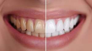 image of teeth whitening transformation - are whitening strips bad for your teeth? Learn with Abington Center for Cosmetic & Family Dentistry