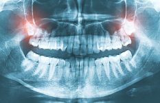 9 Ways to Speed Up Wisdom Teeth Recovery