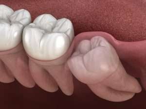 medical illustration of compacted wisdom tooth - learn how to speed up wisdom teeth recovery with Abington Center for Cosmetic & Family Dentistry, a local dentist in Clarks Summit, PA near Scranton, PA.