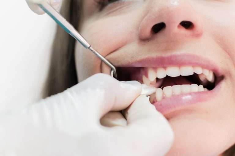 Read more about the article When to Stop Using Gauze After a Tooth Extraction