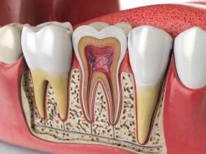 image of root canal graphic - what are the signs you may need a root canal? Learn with Abington Center for Cosmetic & Family Dentistry, a dentist office located in Clarks Summit, PA. 
