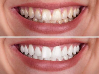 Close-up Of A Smiling Woman's Teeth Before And After Whitening