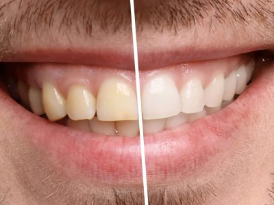 Smiling man before and after teeth whitening procedure, closeup