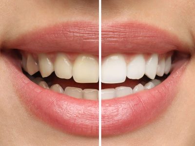 Collage with photos of woman before and after teeth whitening, closeup