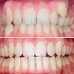 Before & After Results See real transformations from patients who chose Invisalign® at Abington Center for Cosmetic & Family Dentistry.