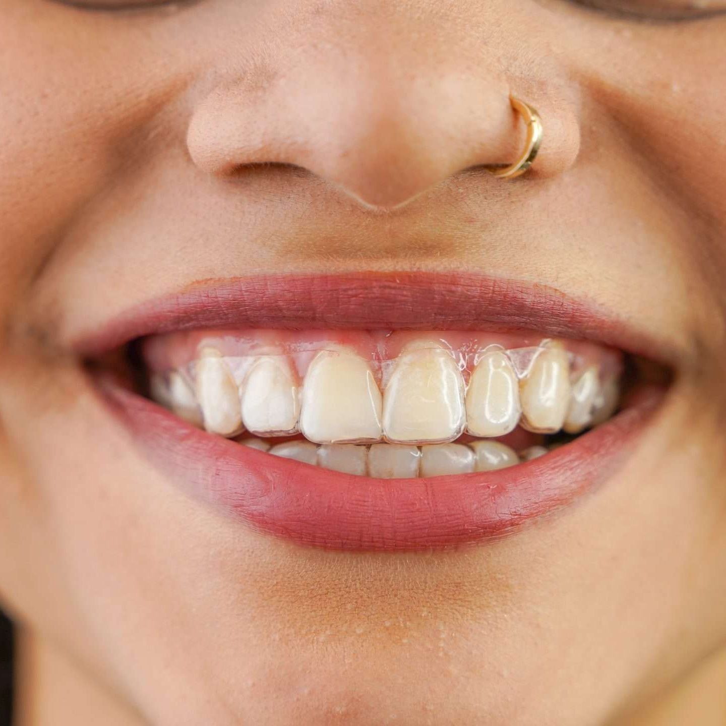 Benefits of Invisalign® Why Patients Love Clear Aligners Nearly invisible — discreet teeth straightening for Clarks Summit and Scranton-area patients Removable — eat what you love and brush normally Gentle, comfortable fit — no wires, brackets, or tightening appointments Improved confidence and self-esteem Fewer office visits than traditional braces, ideal for busy families and professionals Predictable results — advanced digital treatment planning ensures accuracy from start to finish