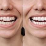 Before & After Results See real transformations from patients who chose Invisalign® at Abington Center for Cosmetic & Family Dentistry.