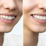 Before & After Results See real transformations from patients who chose Invisalign® at Abington Center for Cosmetic & Family Dentistry.
