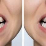 Before & After Results See real transformations from patients who chose Invisalign® at Abington Center for Cosmetic & Family Dentistry.