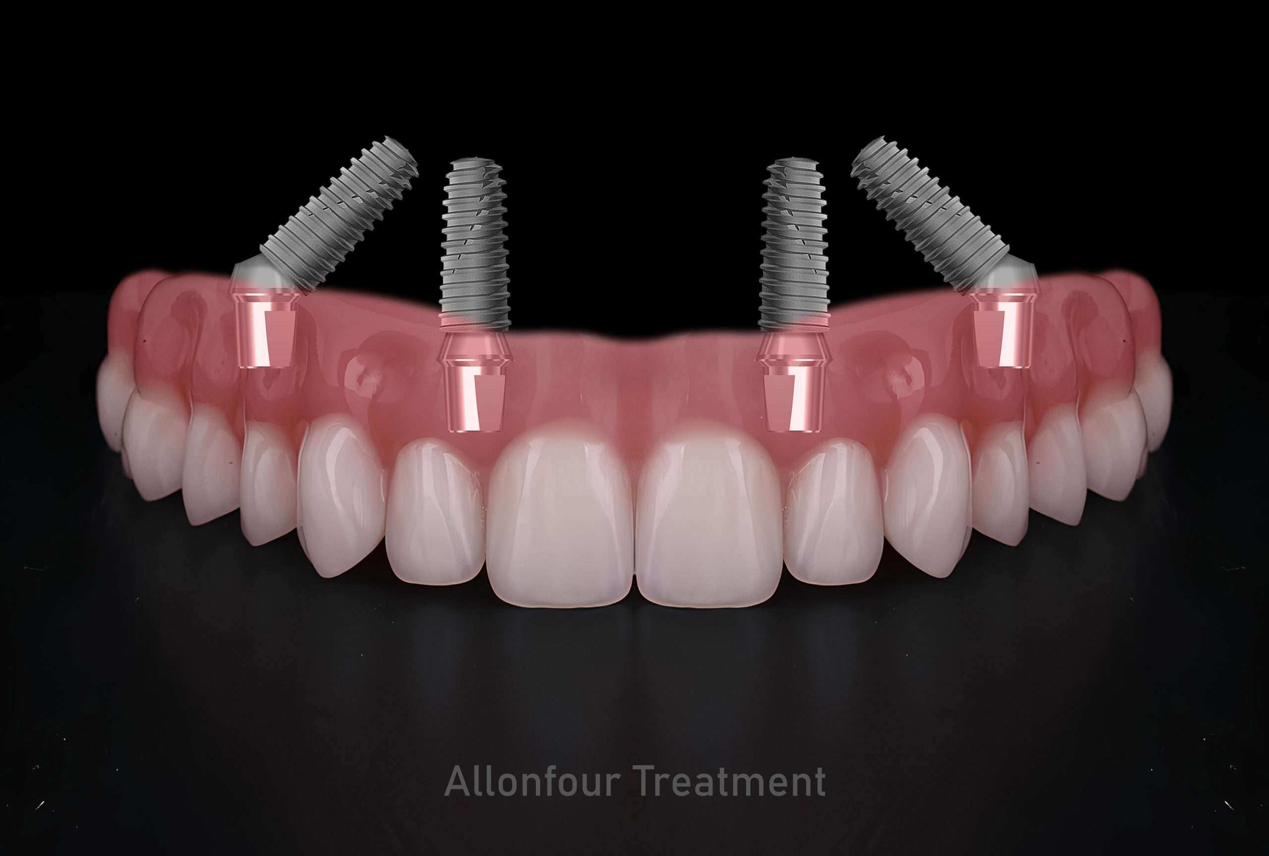 All-on-4 dental implants available at abington dental center